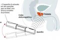 Scanner identifica câncer de próstata sem exame