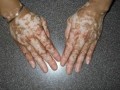 Vitiligo: cientistas descobrem método que reduz manchas