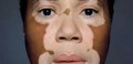 Vitiligo: cientistas descobrem método que reduz manchas